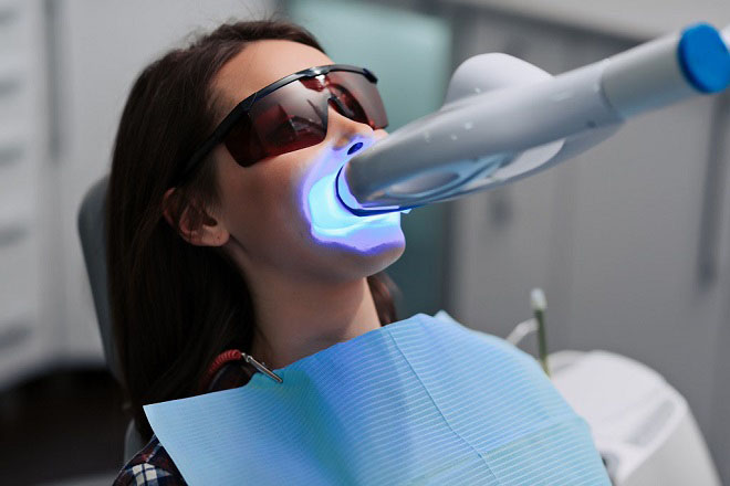 Teeth Whitening at Home Safely: A Complete Guide for a Brighter Smile