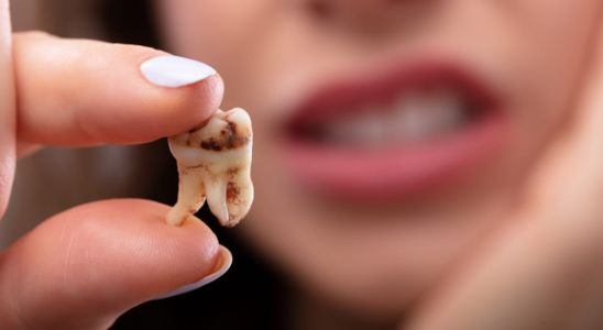 How to Prevent Tooth Decay Naturally: Simple Steps for a Healthy Smile